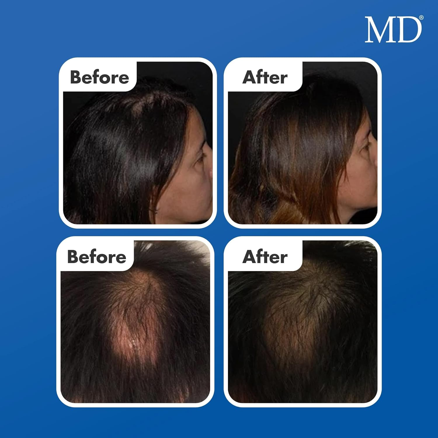 MD Factor Suero Natural Para El Crecimiento Del Cabello | Follicle Energizer Serum: Evita El Adelgazamiento Del Cabello Y La P&eacute;rdida De Cabello Al Estimular Los Fol&iacute;culos Capilares Para Producir Un Ca image number 3