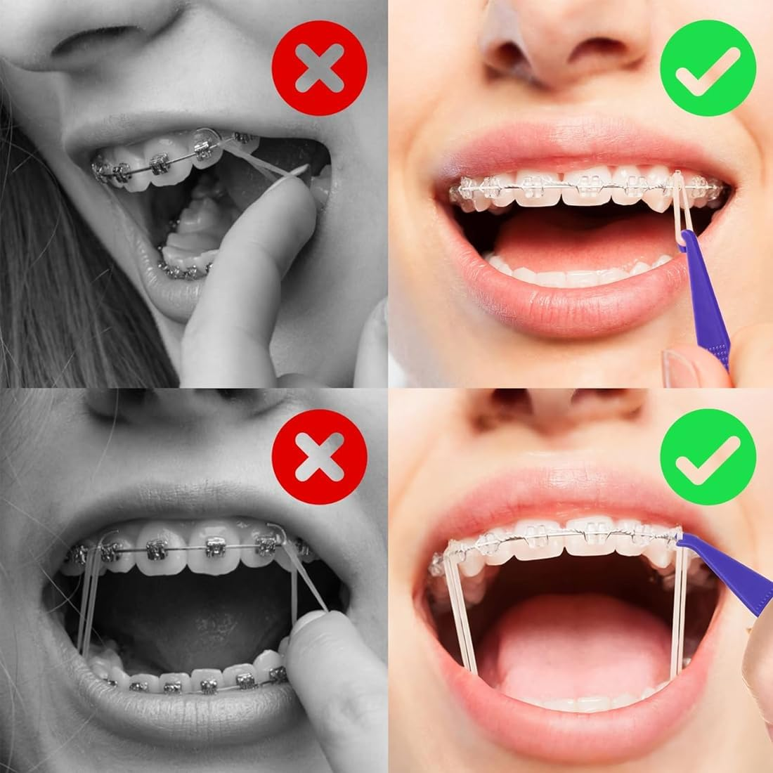 Pack of 10 Orthodontic Elastic Disposable Plastic Braces for Braces, Material Placement Removal Tools, Orthodontic Disposable Plastic Braces (Mixed Colour) image number 4