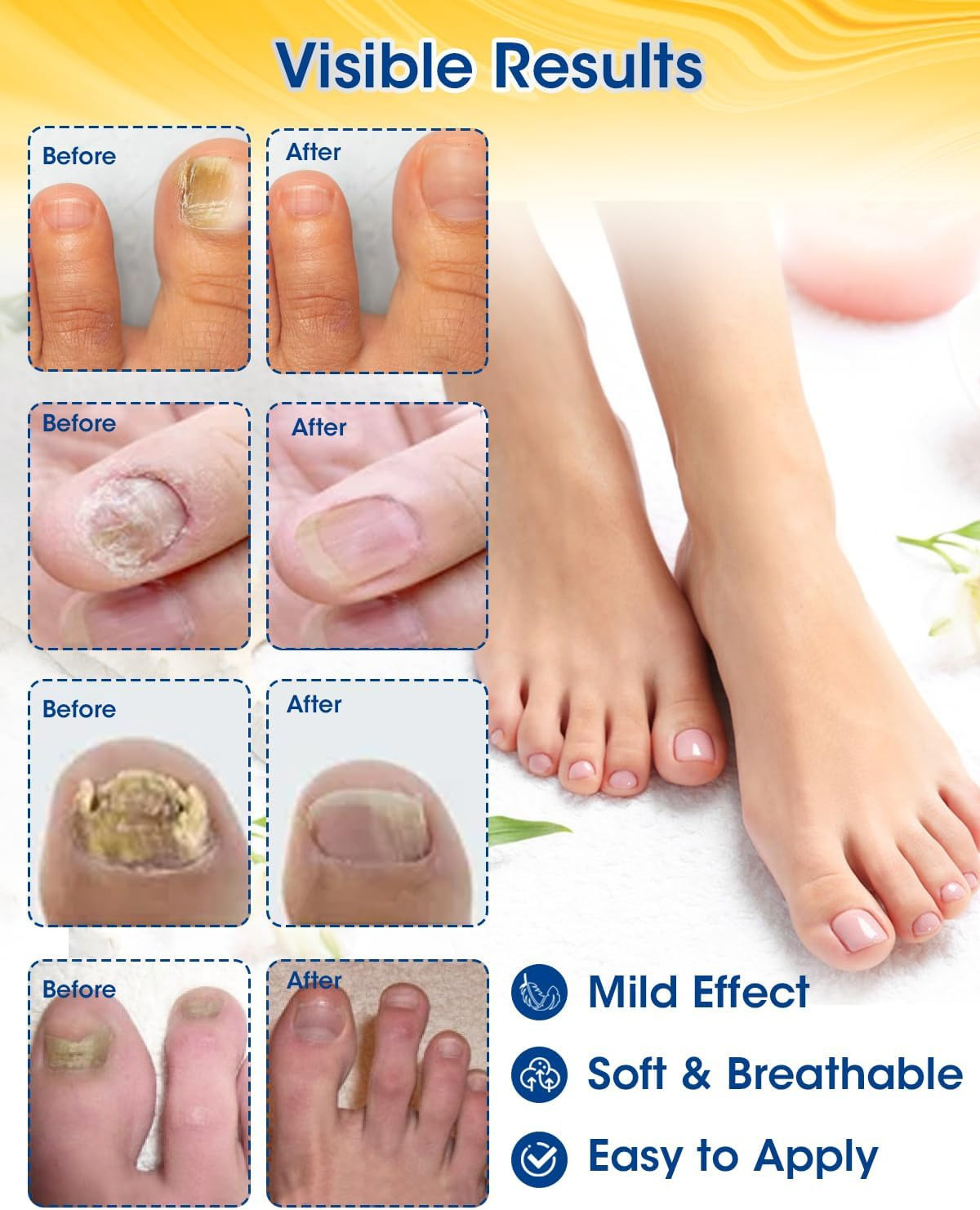 MYMULIKE Nail Repair Patches Extra Strength, 28 Count, Nail Repair for Damaged Nails, 8 Hour Nighttime Toenail Renewal Patches, Restores Appearance of Discolored, Thickened, Damaged Nails image number 5