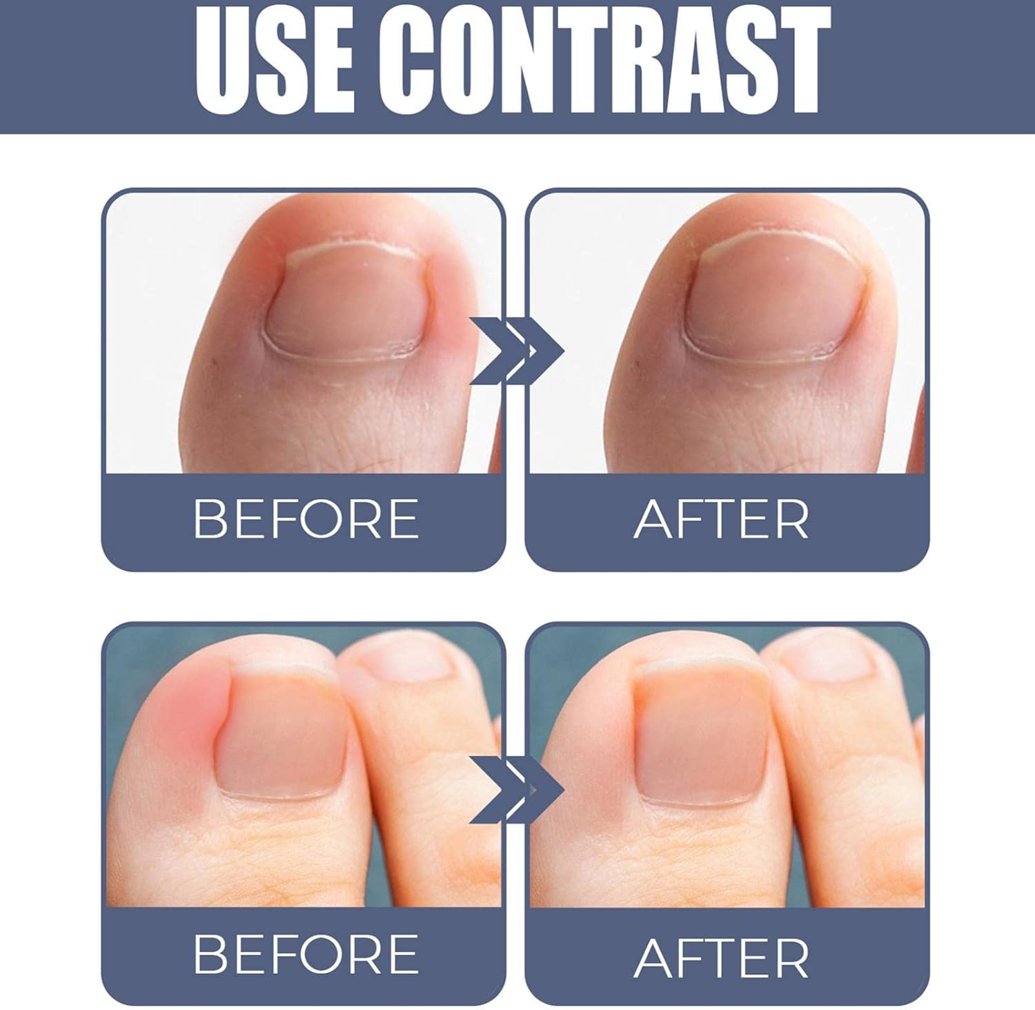 Ingrown Toenail Corrector | Professional Ingrown Toenail Drops Liquid Relief Oil,10Ml Ingrown Toenail Reliever and Softener for Easy Trimming, Toenail Pedicure image number 4