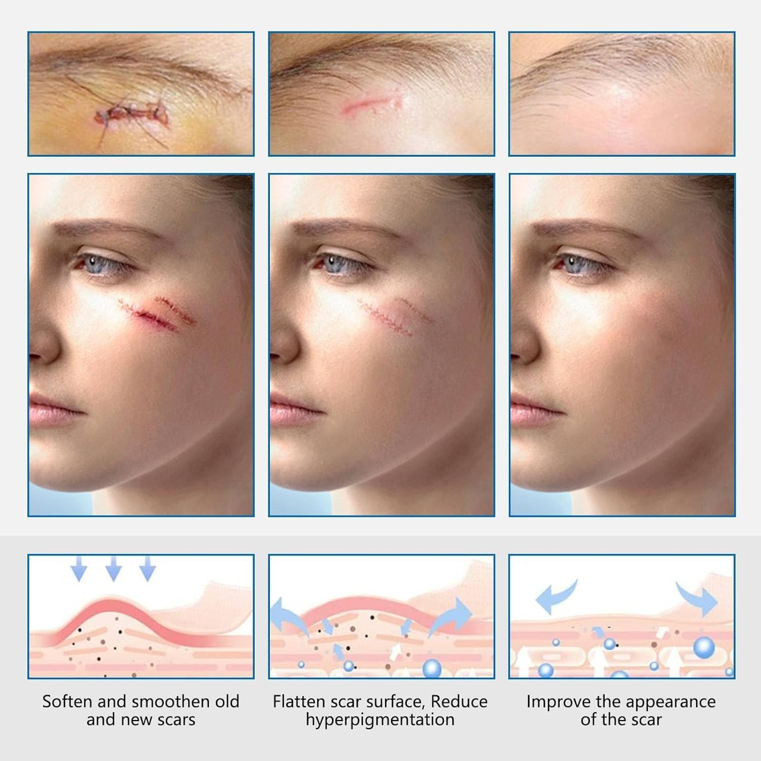 Silicone Scar Sheets (1Pcs 2.5 X 150Cm Roll), Professional Scar Removal Tape, Scar Tape Roll, Scar Silicone Strips for Face & Body, for C-Section, Surgery, Burn, Keloid, Acne image number 2