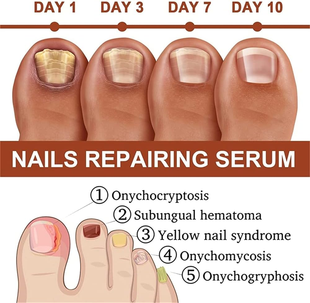 7 Days Nail Growth and Strengthening Serum, 20Ml Nail Growth and Strength Serum, Nail Growth & Strengthening Oil Serum, Stronger Nails in 1 Week Nail Strengthening Treatment (1Pcs)