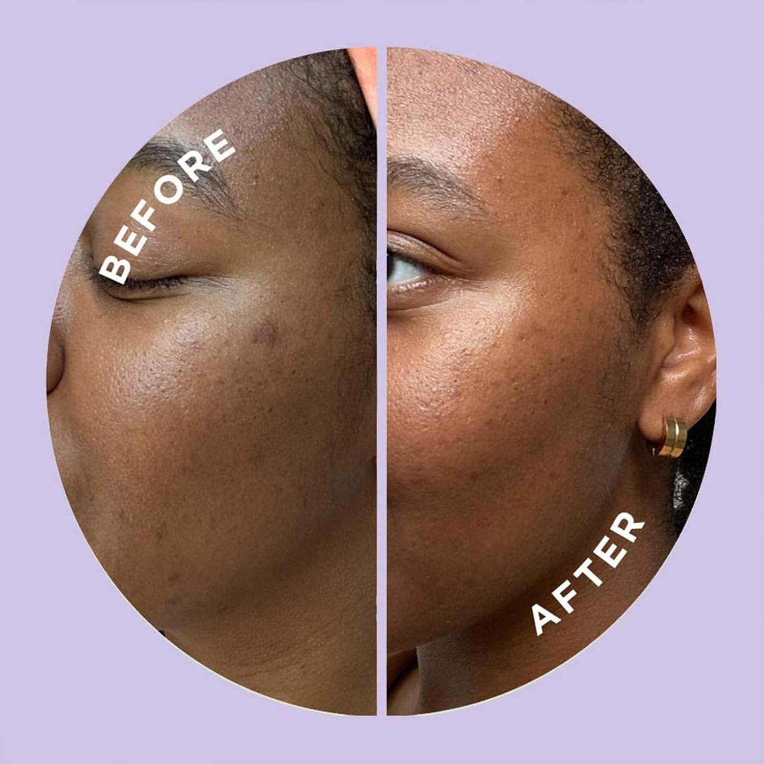 Zitsticka Hyperfade Microdart Pimple Patch, Targets Post-Zit Blemishes, Hydrates & Evens Skin Tone, with Hyaluronic Acid & Vitamin C for Clear, Smooth-Looking Skin (4 Count) image number 3