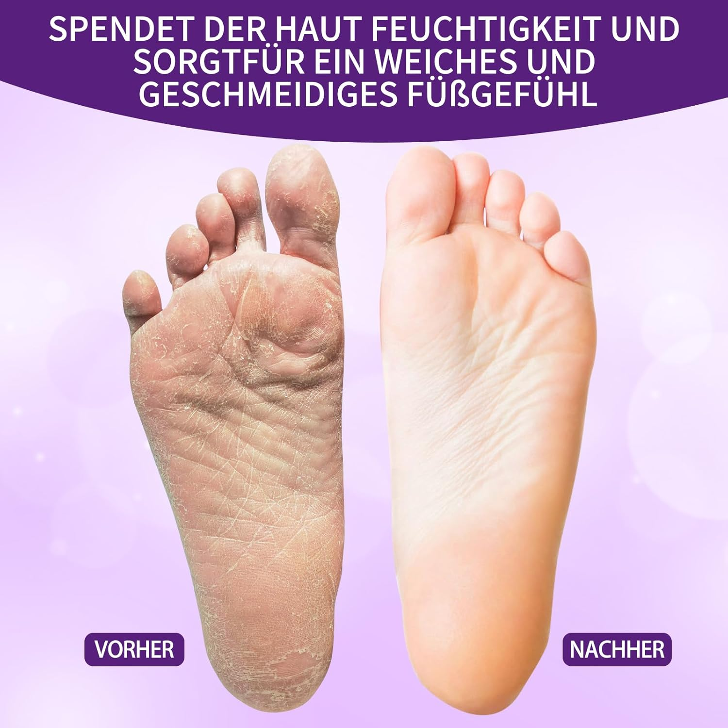 Nbc Beautilab Callus Remover, 25 Pieces Callus Remover with Pumice Stone Individually Wrapped Use with Pumice Stone for Faster Removal of Calluses - Lavender Fragrance image number 1