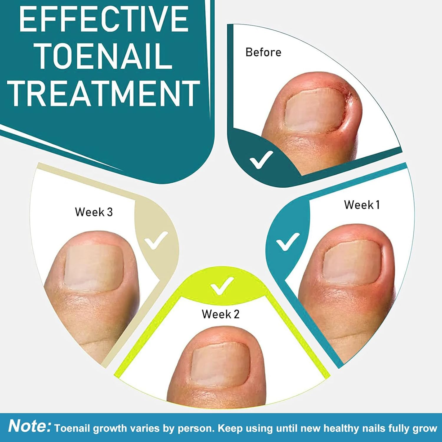 50Pcs Ingrown Toenail Care Strips &ndash; Plant-Based Toenail Support, Rapid Soothing & Comfort Boost, Natural Growth Encouragement, Breathable Design & Easy Application for Daily Use image number 4