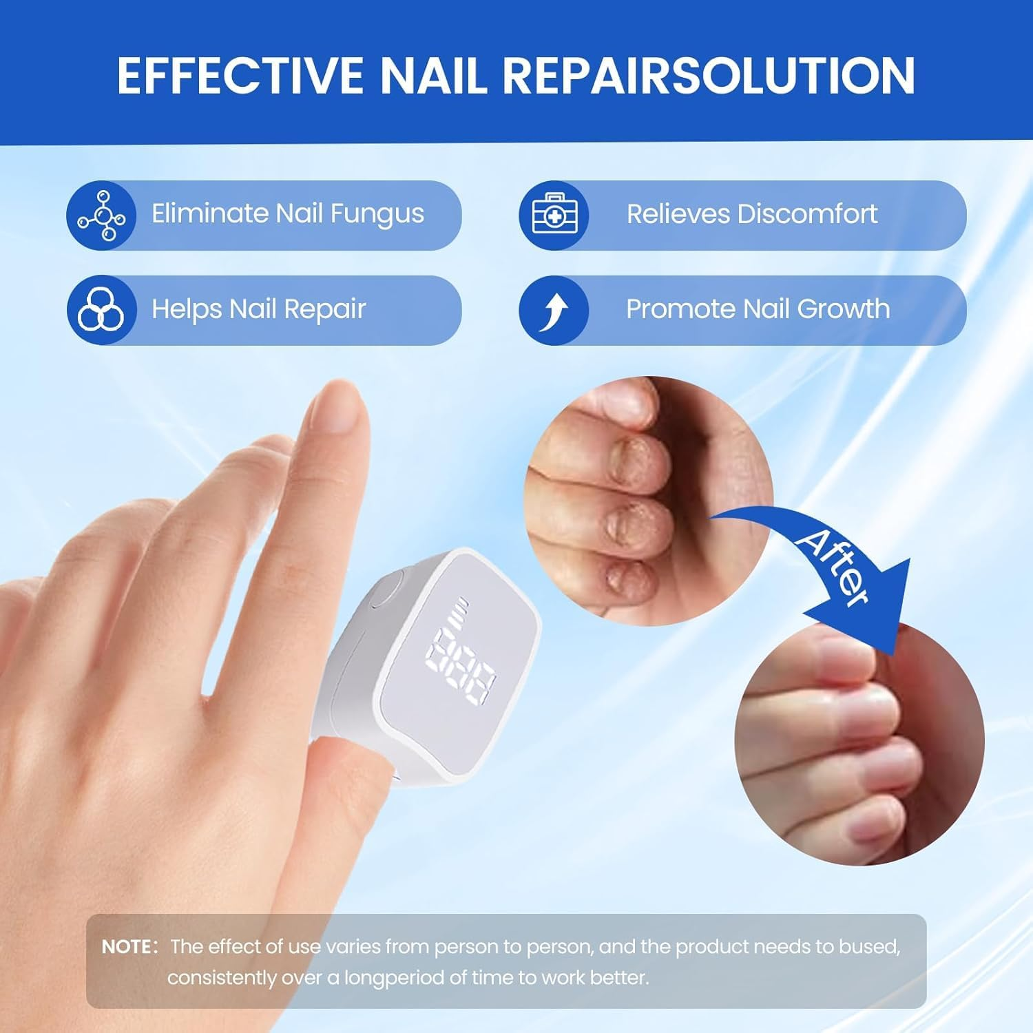 UV Light Nail Fungus Laser Device, Onychomycosis Laser Device with 470Nm Blue & 910Nm Infrared Light, Toenail Fungus Ideal for Home Treatment with LED Time Display for Home Use image number 6