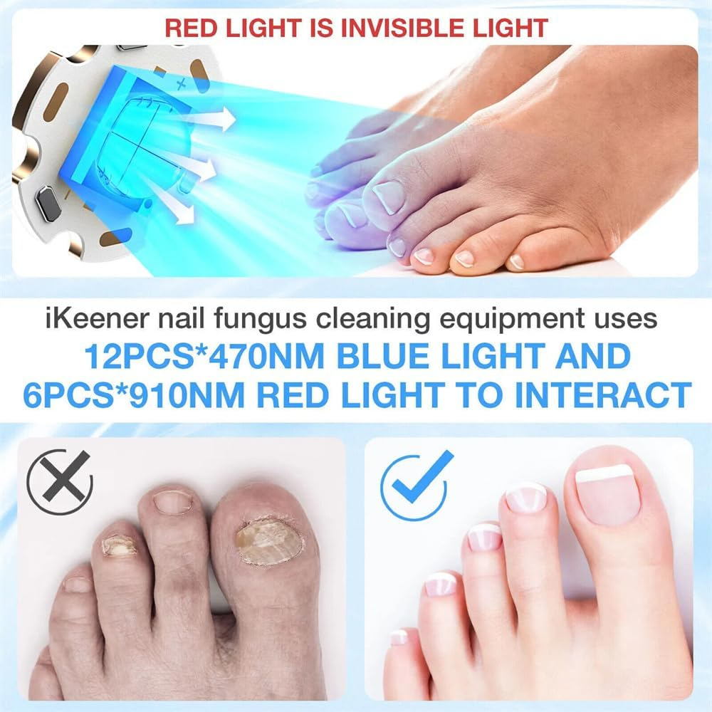 Nail Fungus Cleaning Laser Device Blue Light Nail Therapy for Fingernail Toenail image number 3