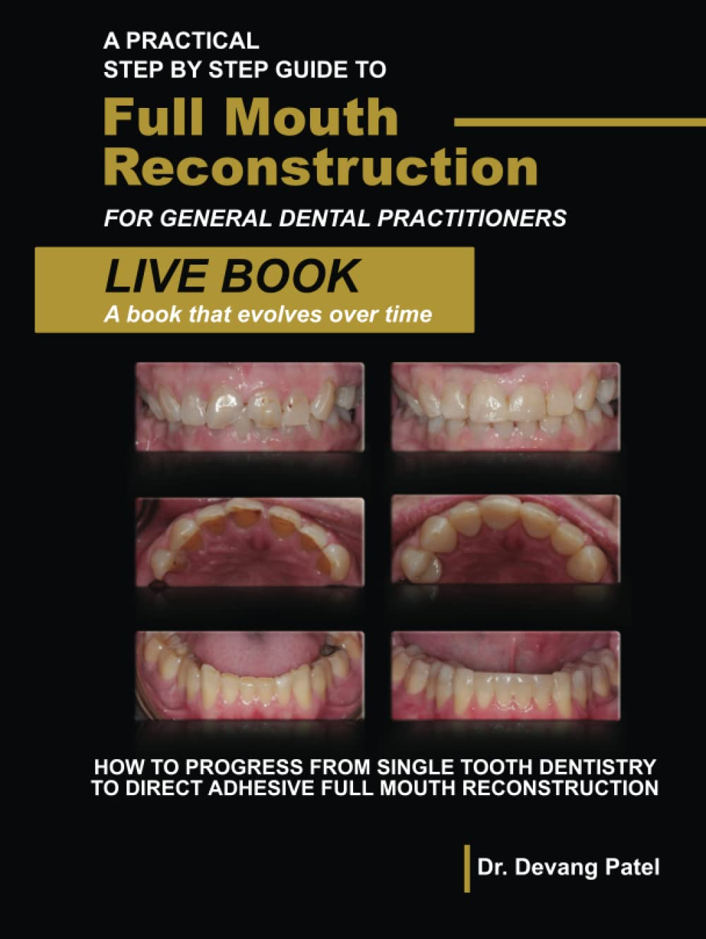A Practical Step by Step Guide to Full Mouth Reconstruction for General Dental Practitioners: How to Progress from Single Tooth Dentistry to Direct Adhesive Full Mouth Reconstruction