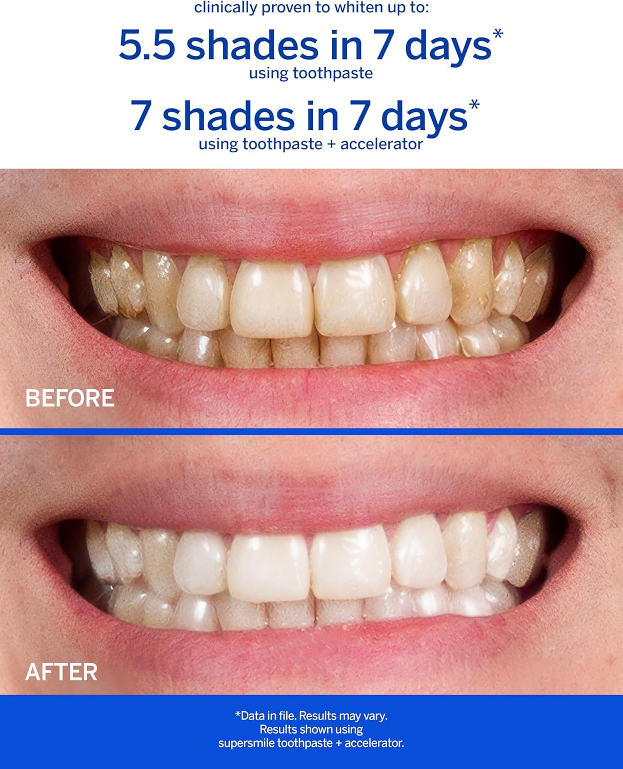 Supersmile Professional Teeth Whitening System - Whitening Toothpaste and Accelerator - Whitens up to 6 Shades image number 5