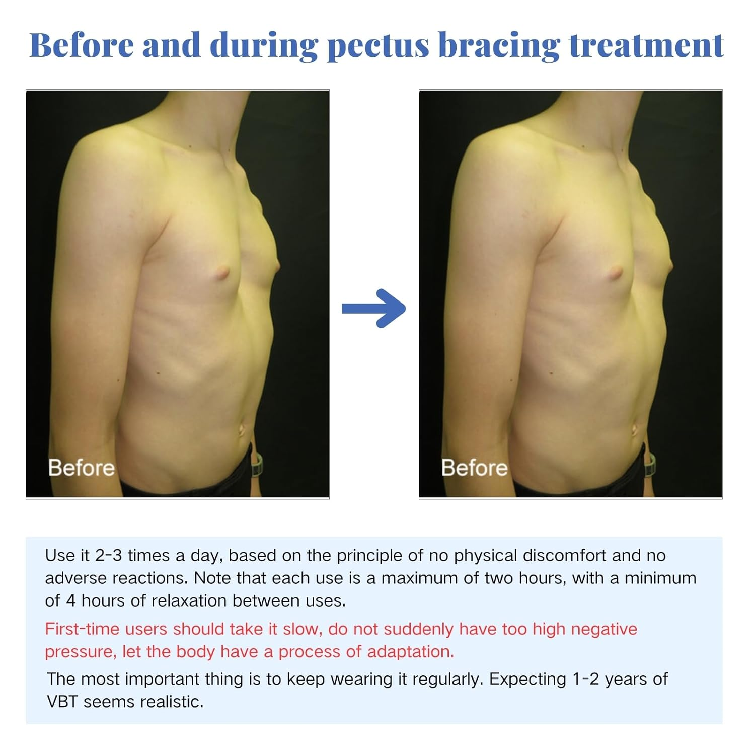 Pectus Excavatum Orthosis Brace, Pectus Excavatum Vacuum Bell with Pressure Gauge, Sternal Depression Support for Sunken Chest, Physical Chest Correction for All Ages (L) image number 5