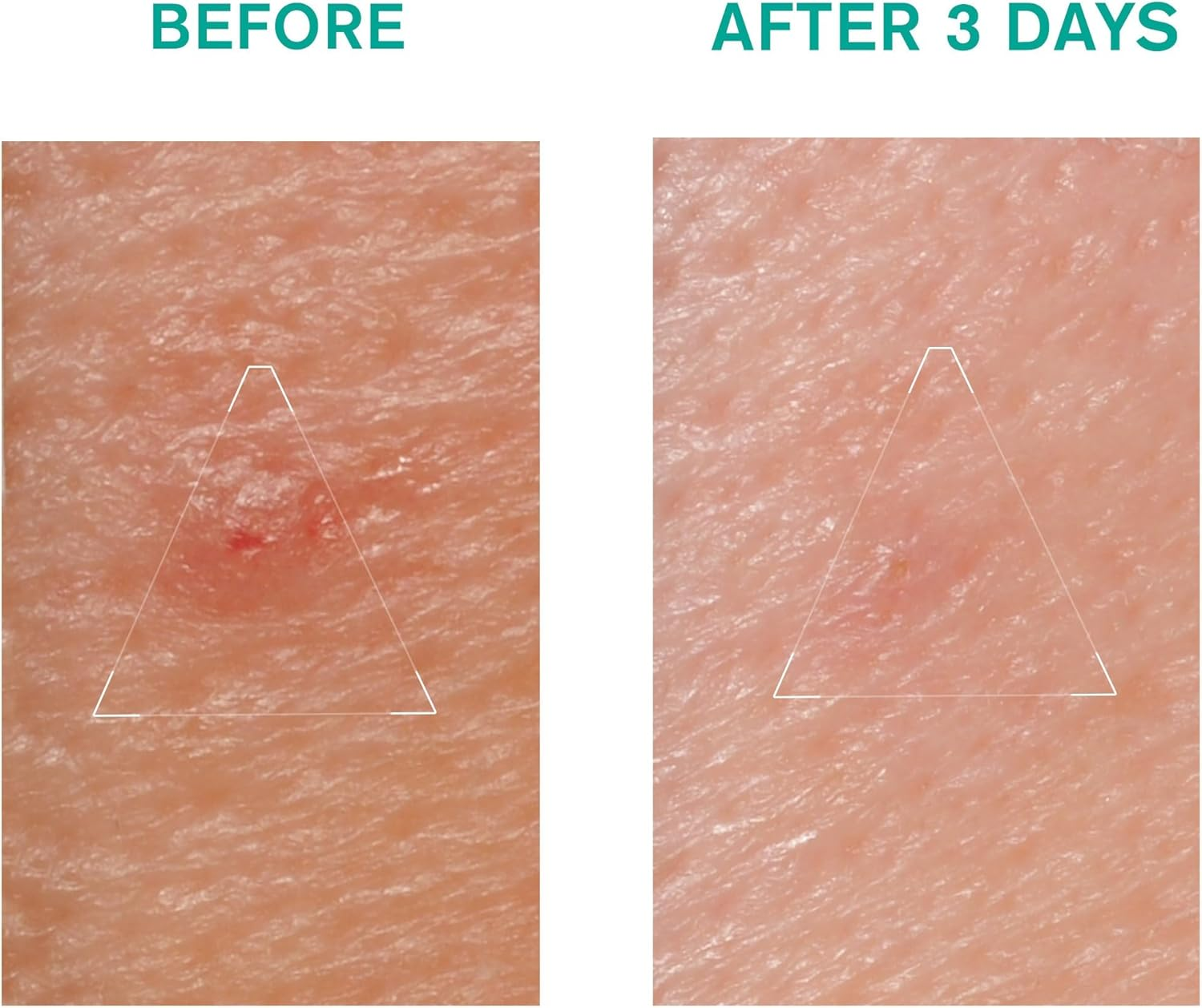 Uriage Hyseac SOS Spot Control Oily Skin with Blemishes Paste, 15G