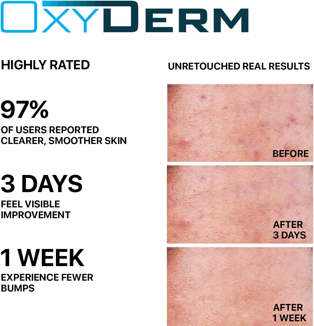 Butt & Thigh Acne Treatment Peel Pads- Exfoliating Treatment Pads to Eliminate Acne Causing Bacteria. Removes Pimples, Blemishes & Ingrown Hairs for the Buttocks & Thigh Area for Both Men & Women. image number 6