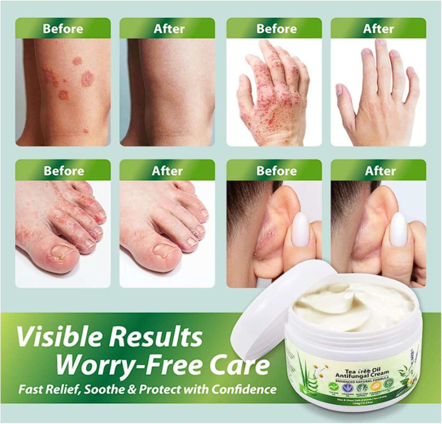 Tea Tree Oil Antifungal Cream, Soothing Moisturiser for Dry & Irritated Skin, Hydrating Foot & Hand Care with Natural Tea Tree Extracts for Men & Women (1Pcs) image number 6