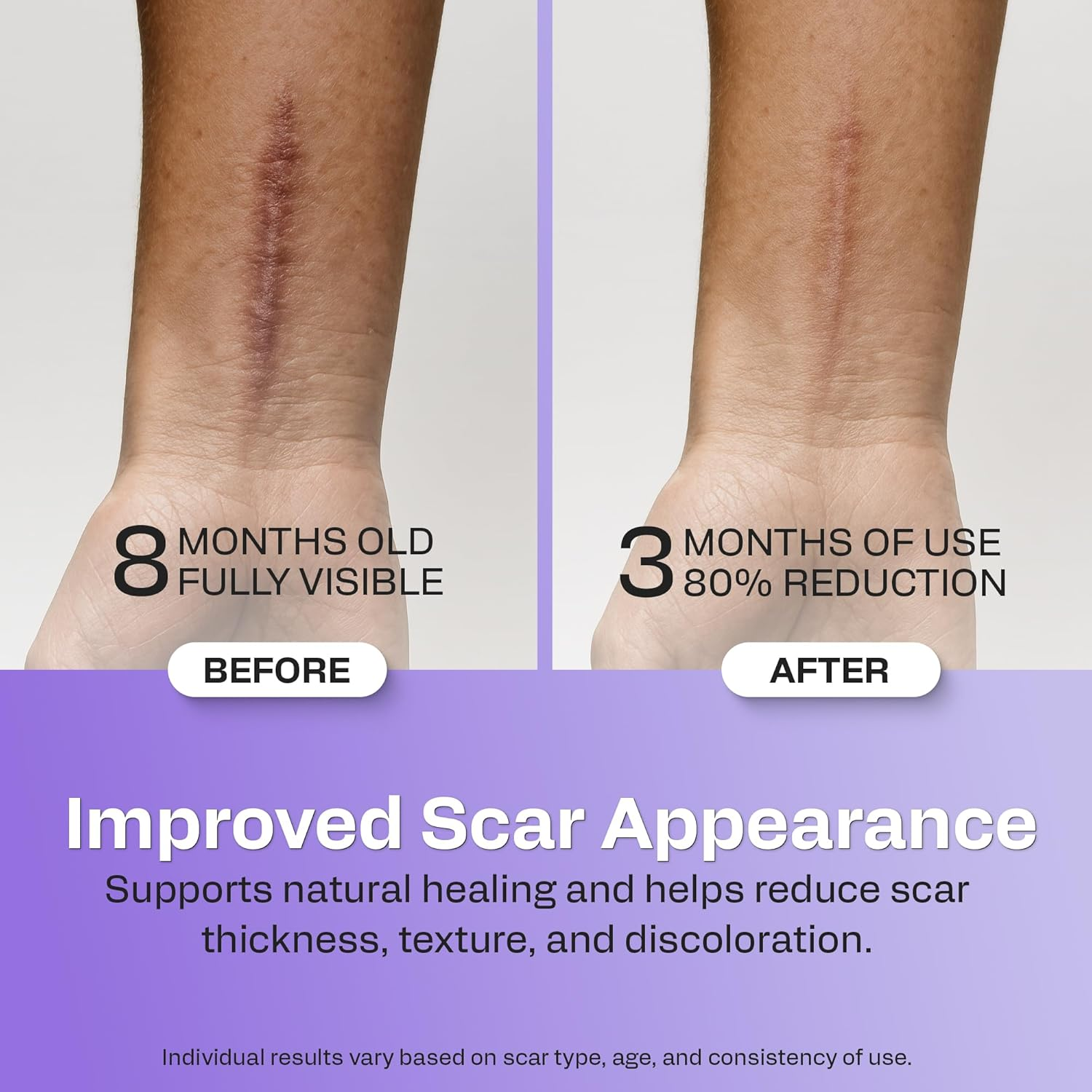 AWD Medical 100% Soft Silicone Gel Tape (1.6" X 60") Highly Comfortable Painless 6-8 Month Supply Acne Scar Treatment C Section Keloid Surgery Premium Hospital Medical Grade (4.1Cm X 150Cm ) image number 2