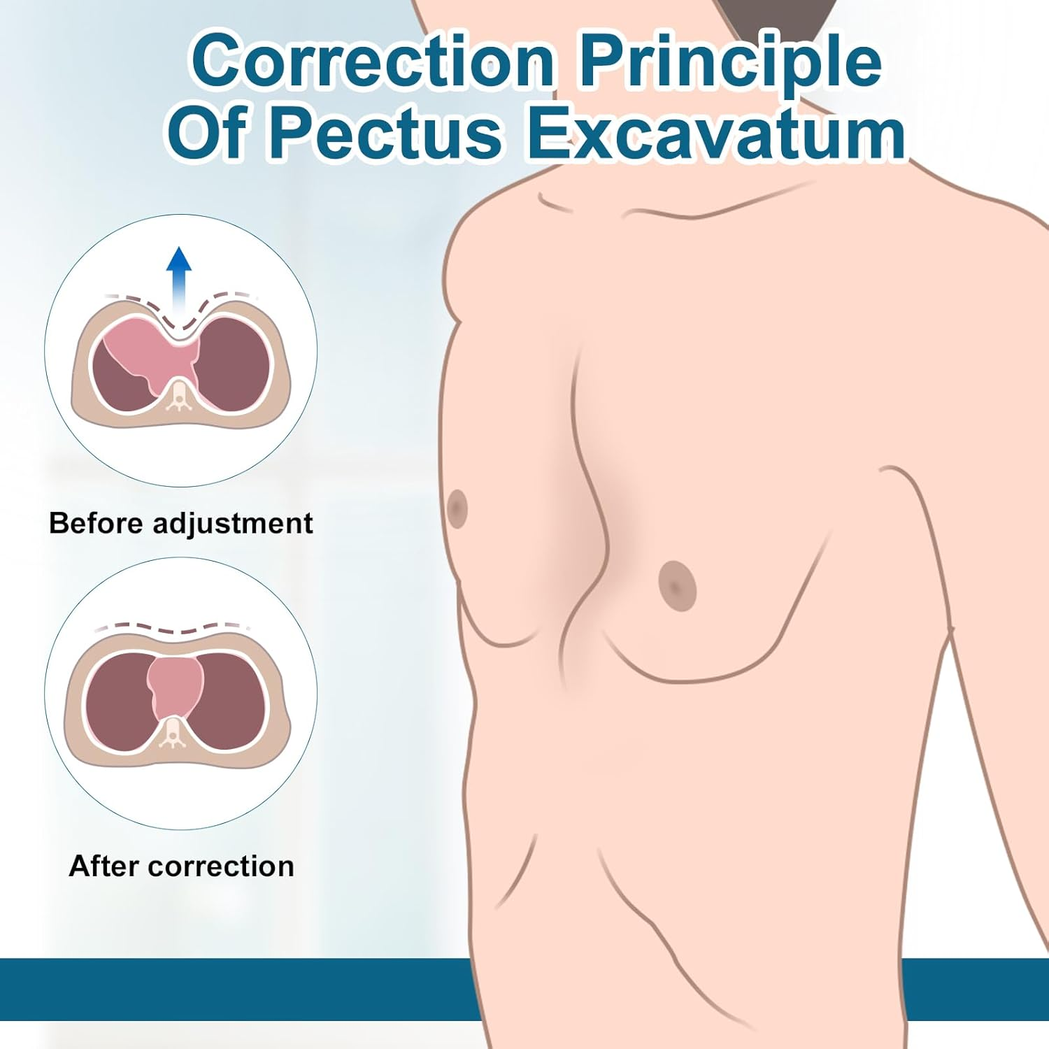 Pectus Excavatum Orthosis Brace, Sternal Depression Support, Thoracic Depression Sunken Sternum Brace for Adults and Child Physical Correction of Pectus Excavatum (M) image number 3