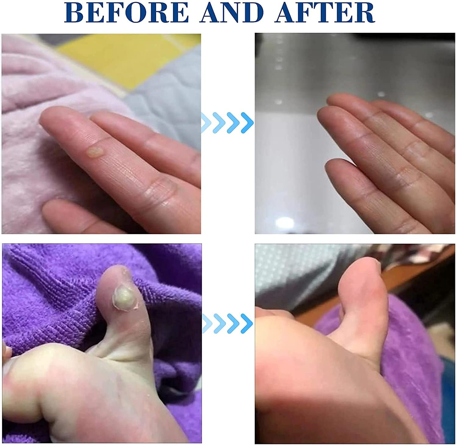 MQ Corn Remover Pads, Wart Remover, Foot Corn Remover Patch, 24 Pcs Corn Removal Pads, Corn Removal Treatment Relieve Corn Pain and Foot Care, Corn Plasters with Hole for Feet, Hand, Toe image number 4