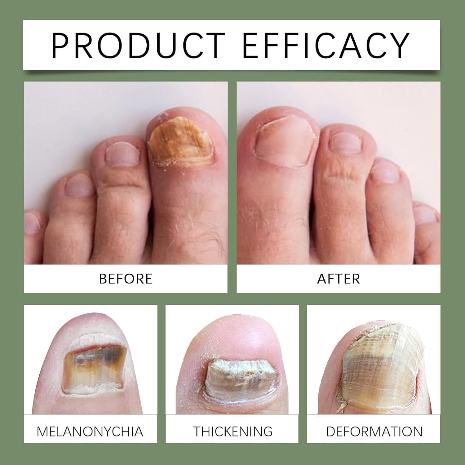 7-Day Nail Care Serum, Ginger Nail Treatment for Toenail and Fingernail for Thin, Nail Growth Serum Oil, Nail Strengthener for Damaged Nails, Restoring Healthy Nails (5PCS) - 2Pcs image number 3