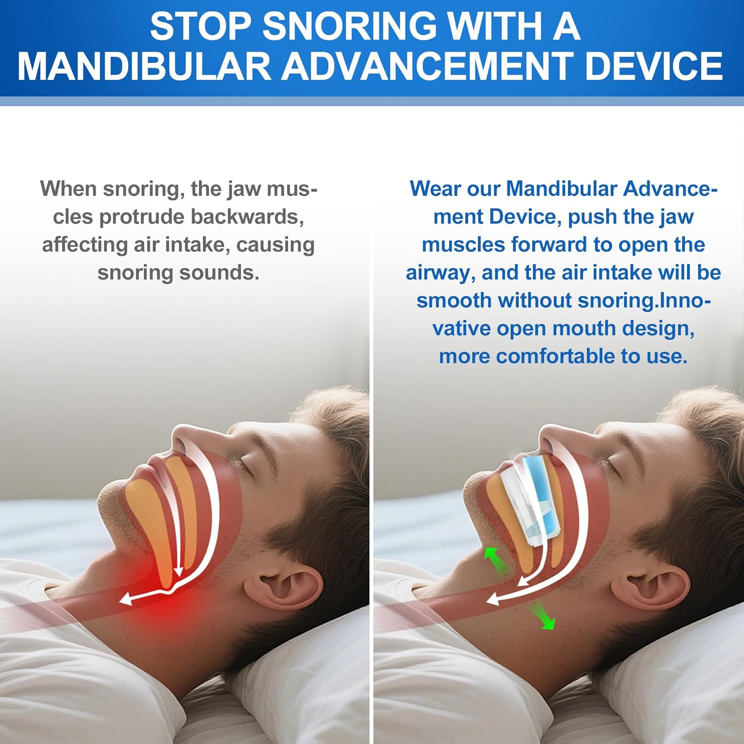 Airsmart anti Snoring Mouthpiece, Moldable and Personalized anti Snoring Mouth Guard, Effective Snoring Prevention Device, Comfortable Fit for Most of Mouth, Severe Snoring Version image number 6