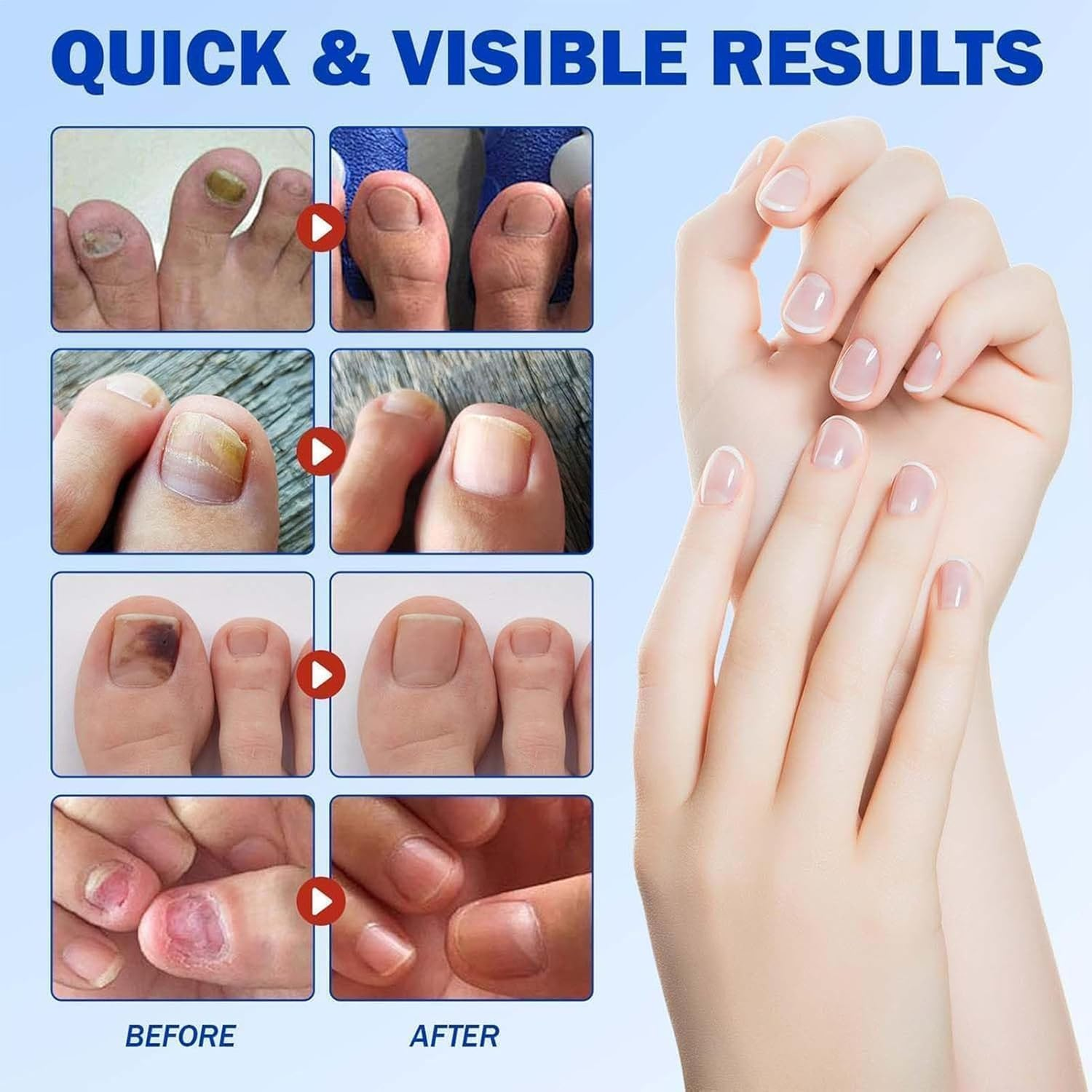 Fungal Nail Patches for Toenails, Nail Health Care Patches, Overnight Toe Nail Treatments for Damaged Nails Foot Nails Repair and Care image number 4