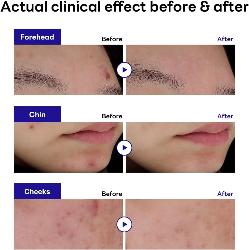 Mediheal Derma Clear Madecassoside Blemish Spot Patch (44) image number 4