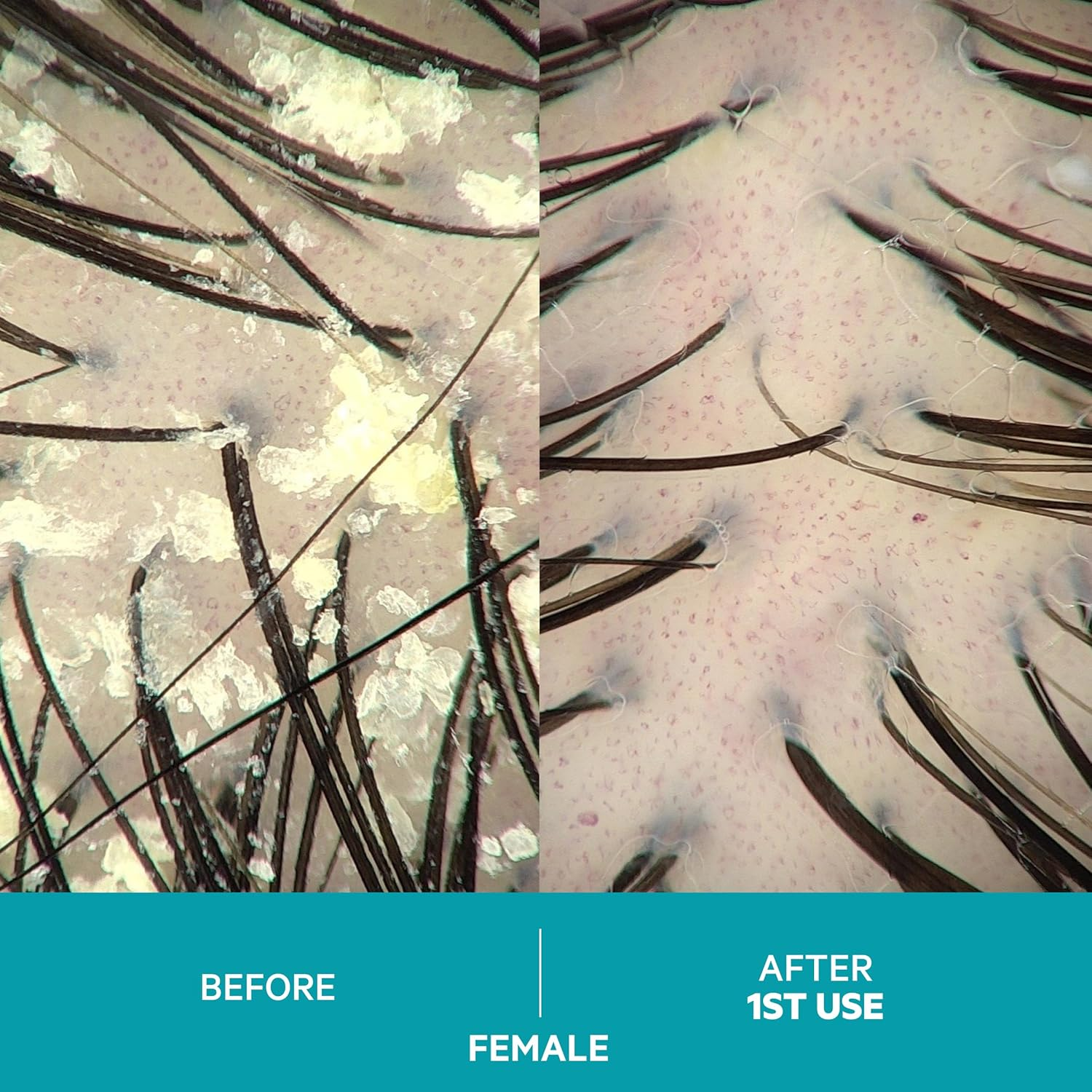 Dandrene Dandruff Shampoo by DS Laboratories &ndash; Shampoo for Itchy, Dry Scalp, Psoriasis Shampoo, Seborrheic Dermatitis Shampoo, for Men and Women (205Ml) - 2 Pack image number 4