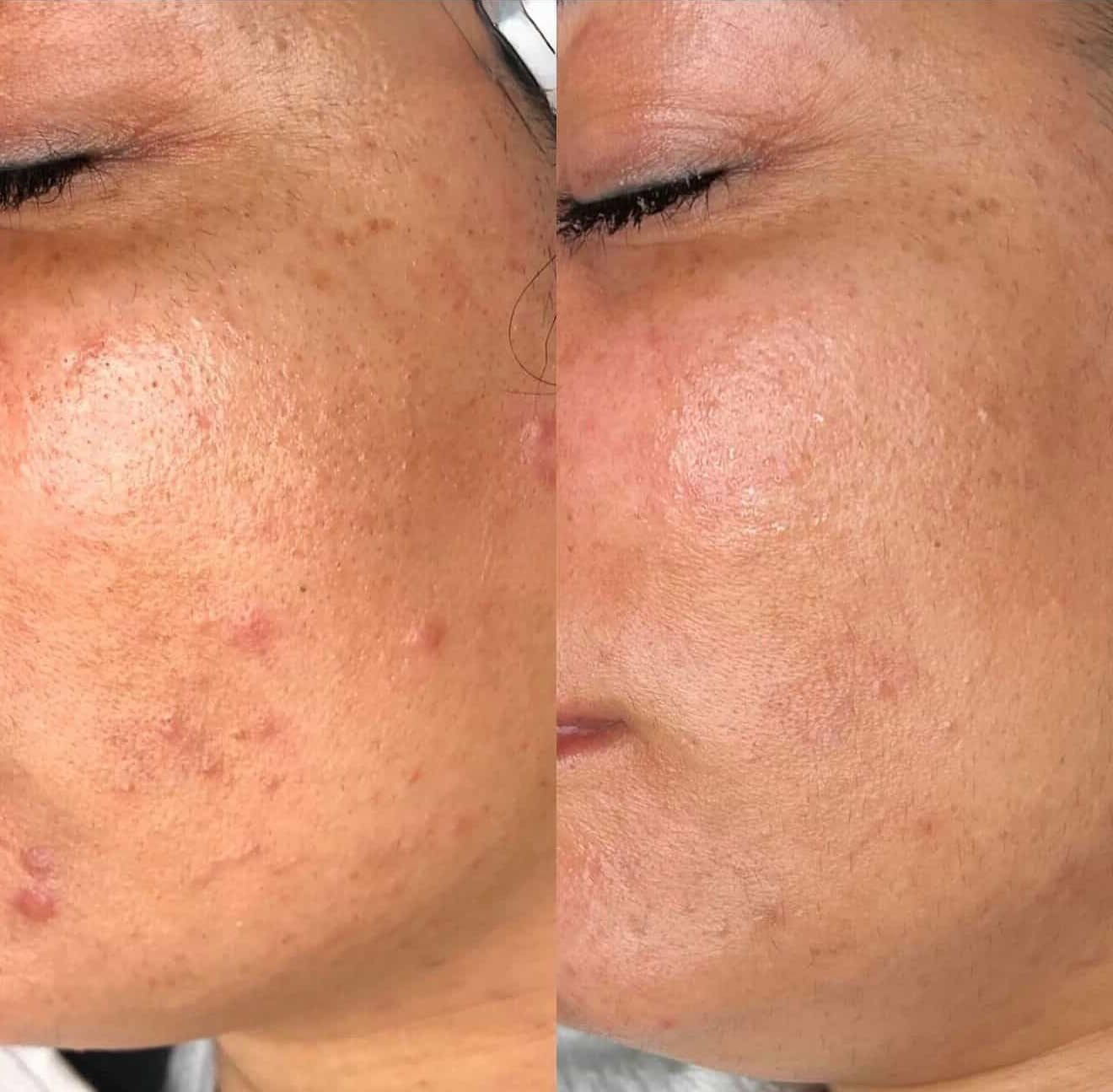 NUNANI - Spicule Treament | Facial Mask Gentle Peel for Blemishes, Texture & Dullness | Hydrating Chlorophyll Formula, Organic Spicules with Antioxidants for Smooth, Glass Skin Glow (5 Treatments)