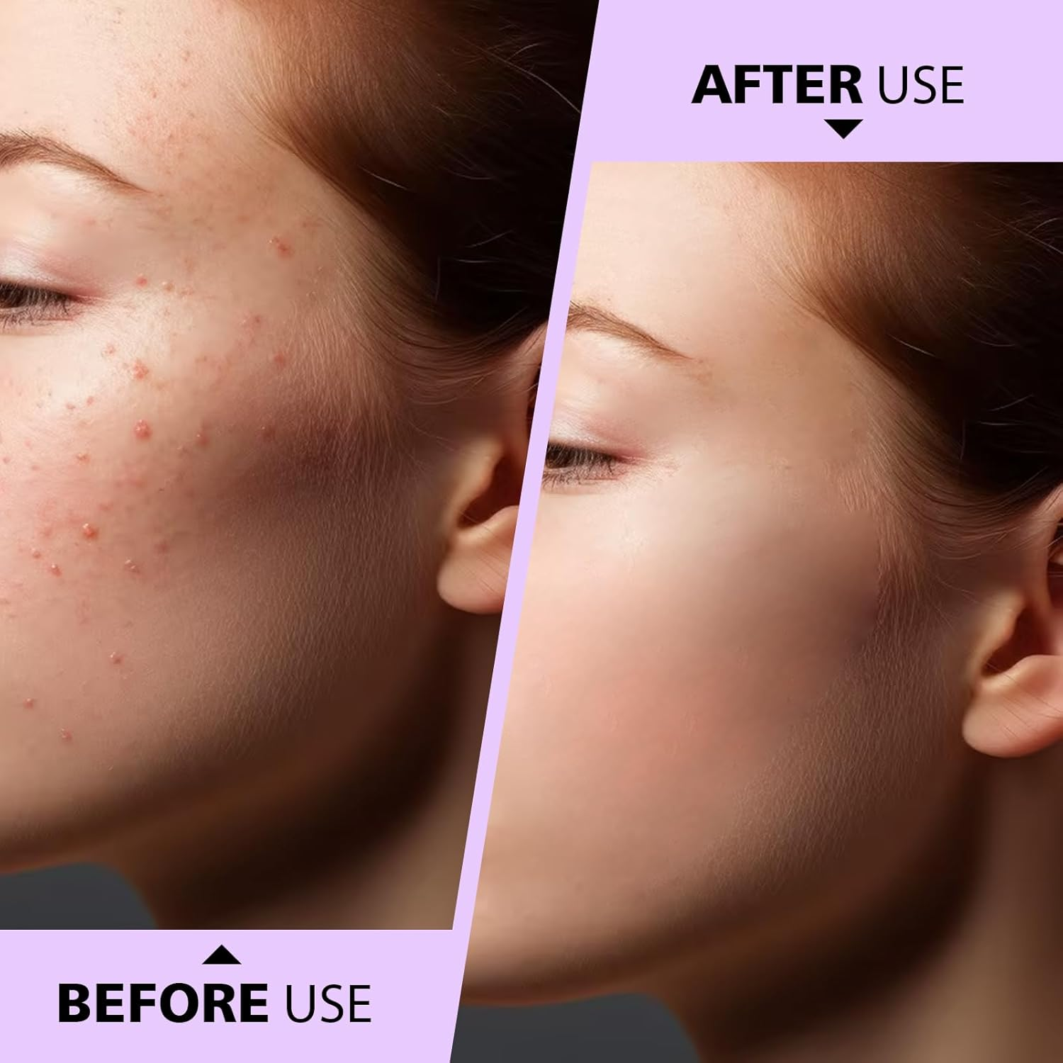 Teenitor Pimple Extractor Acne Treatment Tool Surgical Grade Blackhead Comedone Removal 2-In-1 Popper Tool for Face Nose Blackhead Extractor Tool Silver image number 3