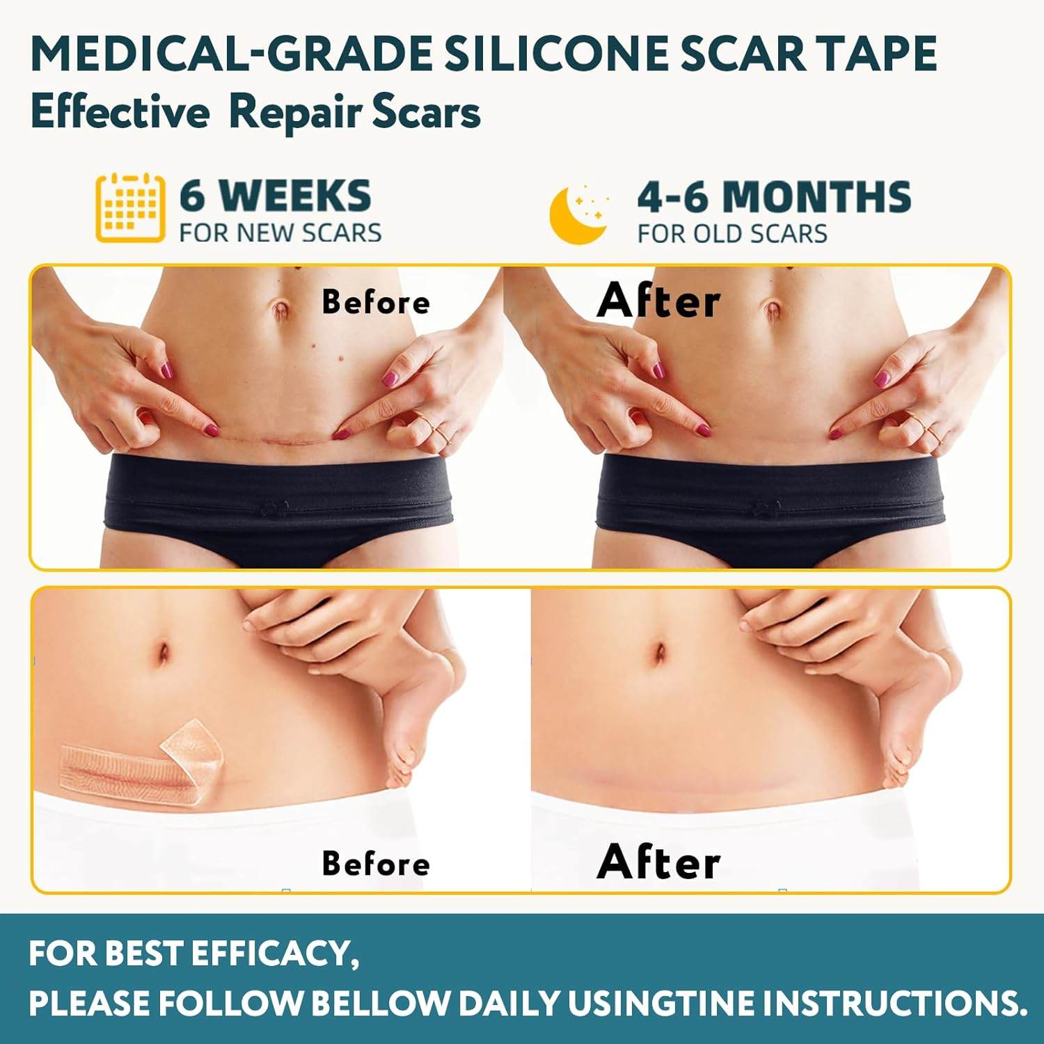 Silicone Scar Sheets, Silicone Scar Tape for Surgical Scars - 60" X 1.6" Roll - 1.5M, Medical Grade Reusable Effective Scar Removal for Keloid, C-Section, Tummy Tuck, and Acne image number 2