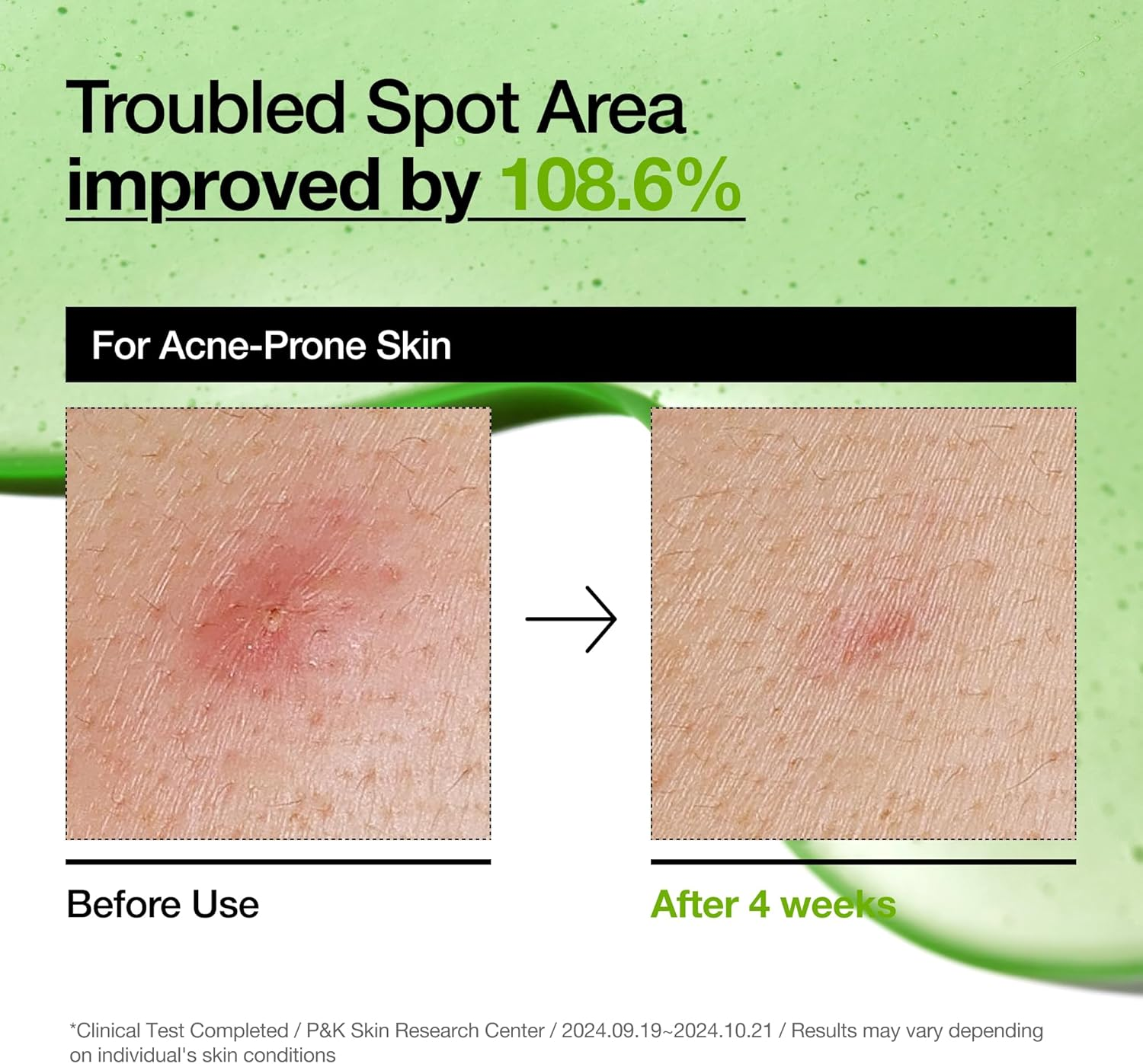 Anua Azelaic Acid 10 Hyaluron Redness Soothing Serum, Facial Serum for Blemish-Prone & Sensitive Skin, Lightweight & Hydrating Blemish Care, Hyaluronic Acid, Korean Skincare, 1.01 Fl Oz. image number 6