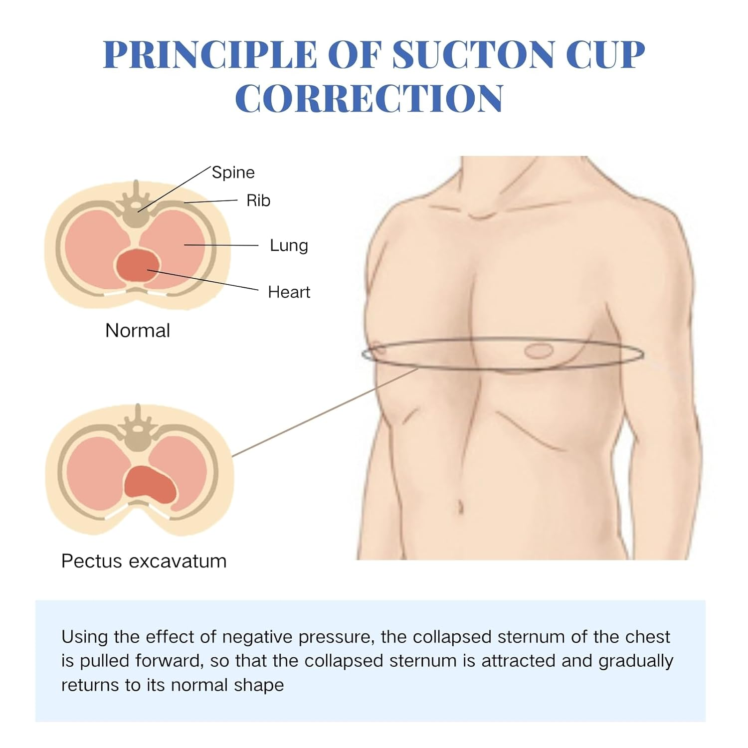 Pectus Excavatum Orthosis Brace, Pectus Excavatum Vacuum Bell with Pressure Gauge, Sternal Depression Support for Sunken Chest, Physical Chest Correction for All Ages (L) image number 2