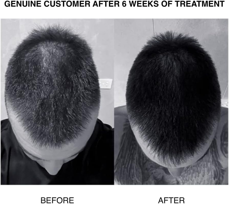 PATRICKS | CD plus Ultra Thickening Conditioner | DHT Blocker | Includes Zinc & Powerful Ingredients to Support Hair Growth & Care | for Moderate to Advanced Hair Loss | 200Ml image number 2