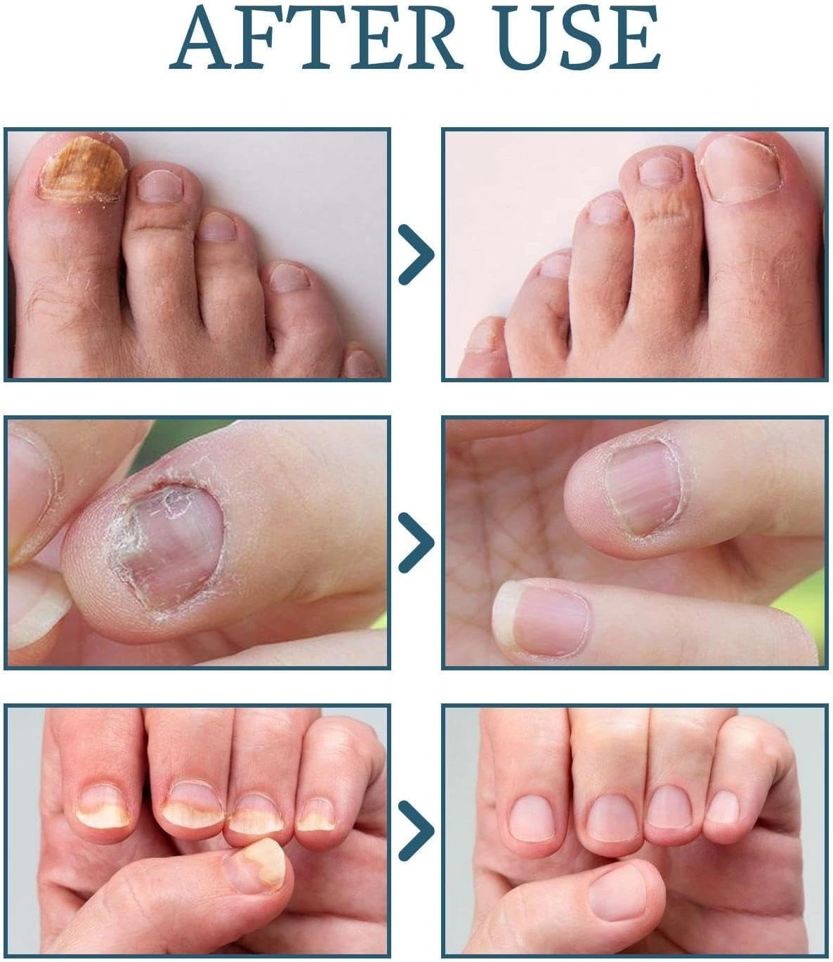 30ML Fungal Nail Treatment for Toenails & Fingernails to Improves Brittleness & Discoloration, Nail Tending for Stronger, Healthier-Looking Nails image number 4