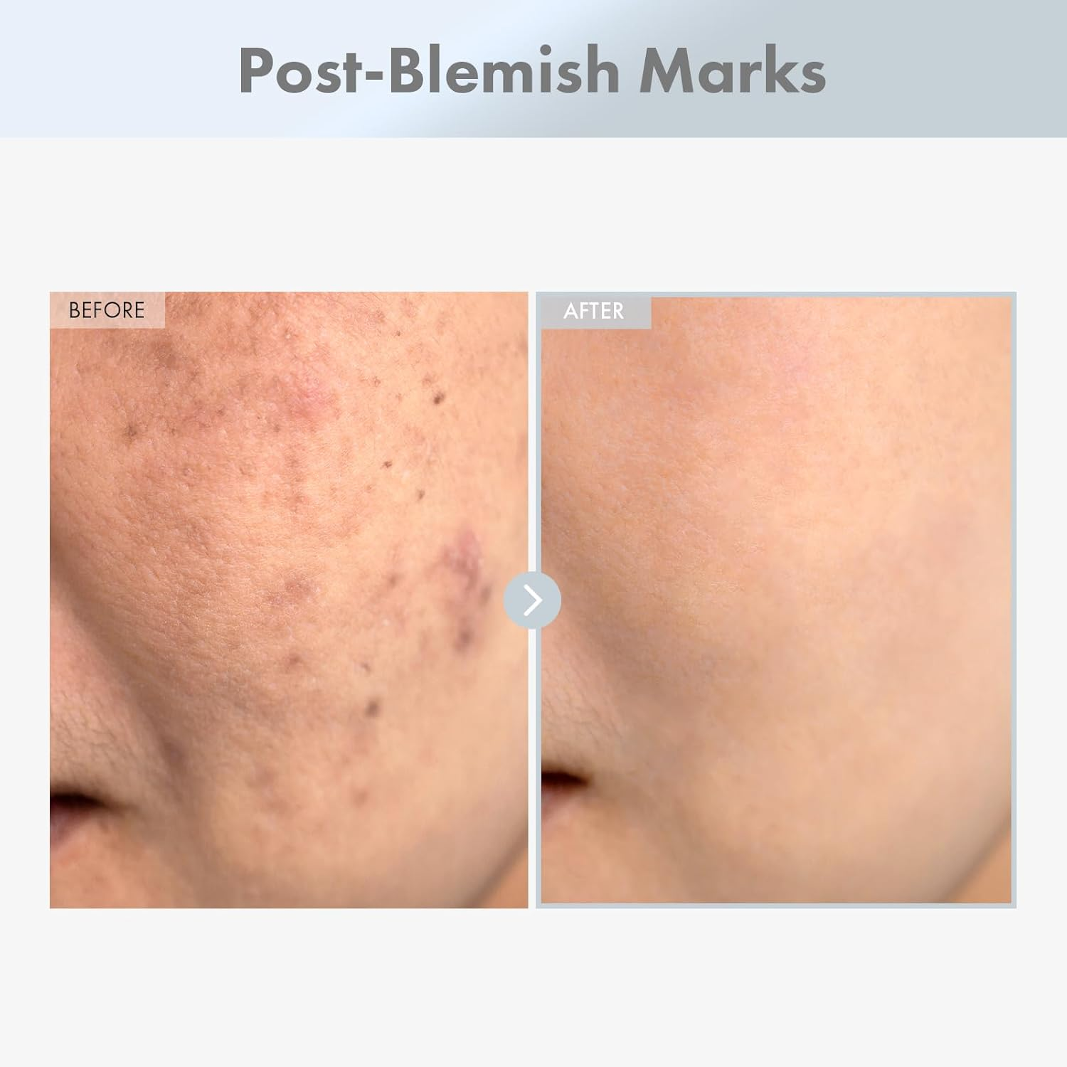 TOSOWOONG Niacinamide 15% Face Serum, 150,100Ppm Niacinamide, Tranexamic Acid, Dark Spot Corrector, Glass Skin, Radiant Complexion, Pore Minimizer, Even Skin Tone, Korean Skin Care, 30Ml, 1.01 Fl.Oz. image number 5