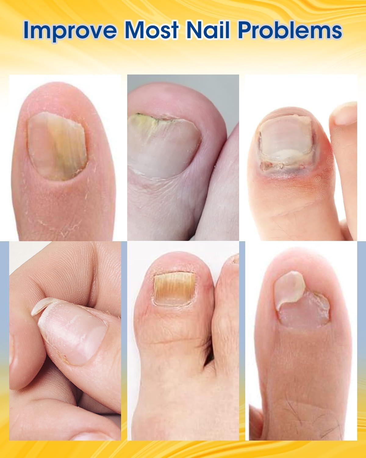 MYMULIKE Nail Repair Patches Extra Strength, 28 Count, Nail Repair for Damaged Nails, 8 Hour Nighttime Toenail Renewal Patches, Restores Appearance of Discolored, Thickened, Damaged Nails image number 6