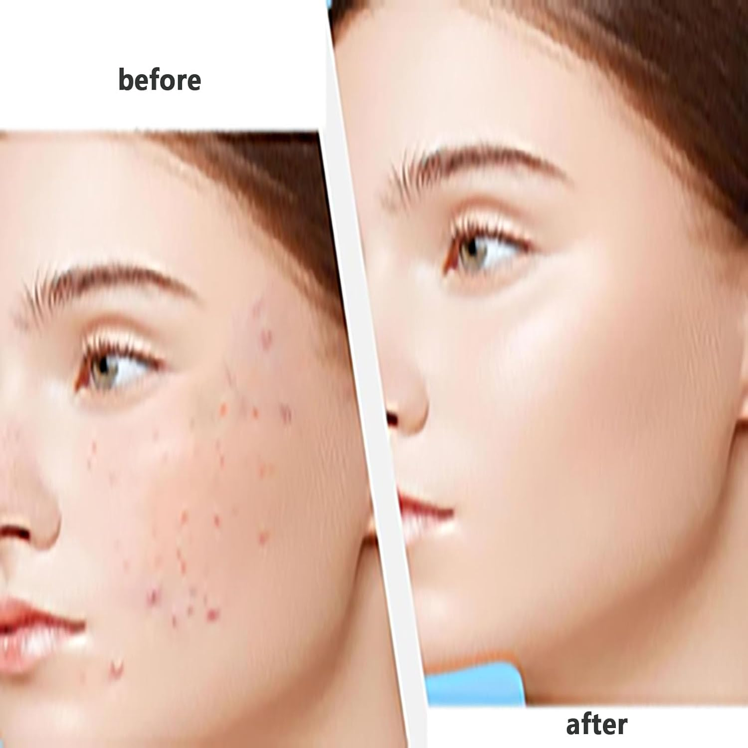 SYGELER Professional Stainless Steel Blackhead Remover Tool - Acne/Pimple Extractor Kit, Painless Blemish Removal for Face, Nose & T-Zone (2Pcs) image number 5