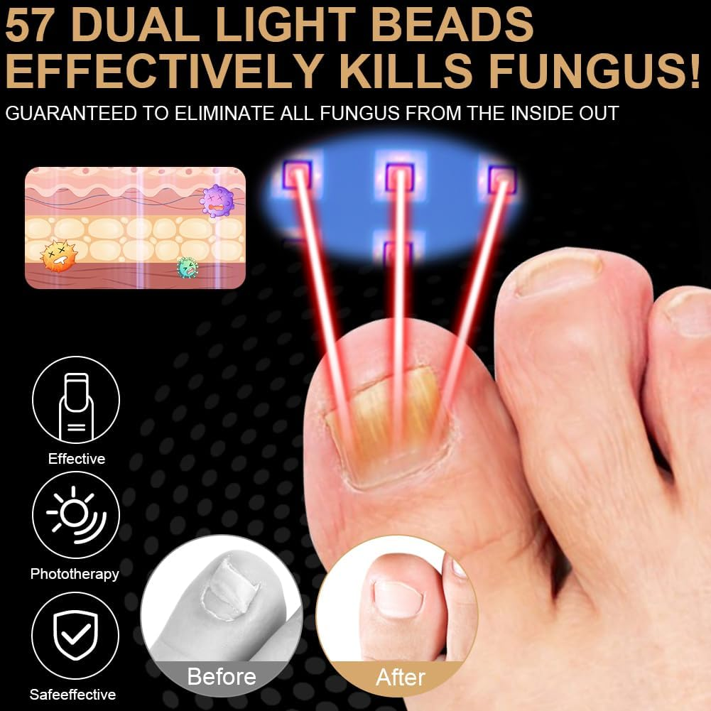 AOOWU Nail Fungus Laser Device, Nail Fungus Laser, Device for Cleaning and Care of Nails for Toenail Diseases, Nail Fungus Laser Device, Nail Fungus Laser, Nail Fungus Laser Fungal Onychomycosis, 365 image number 6