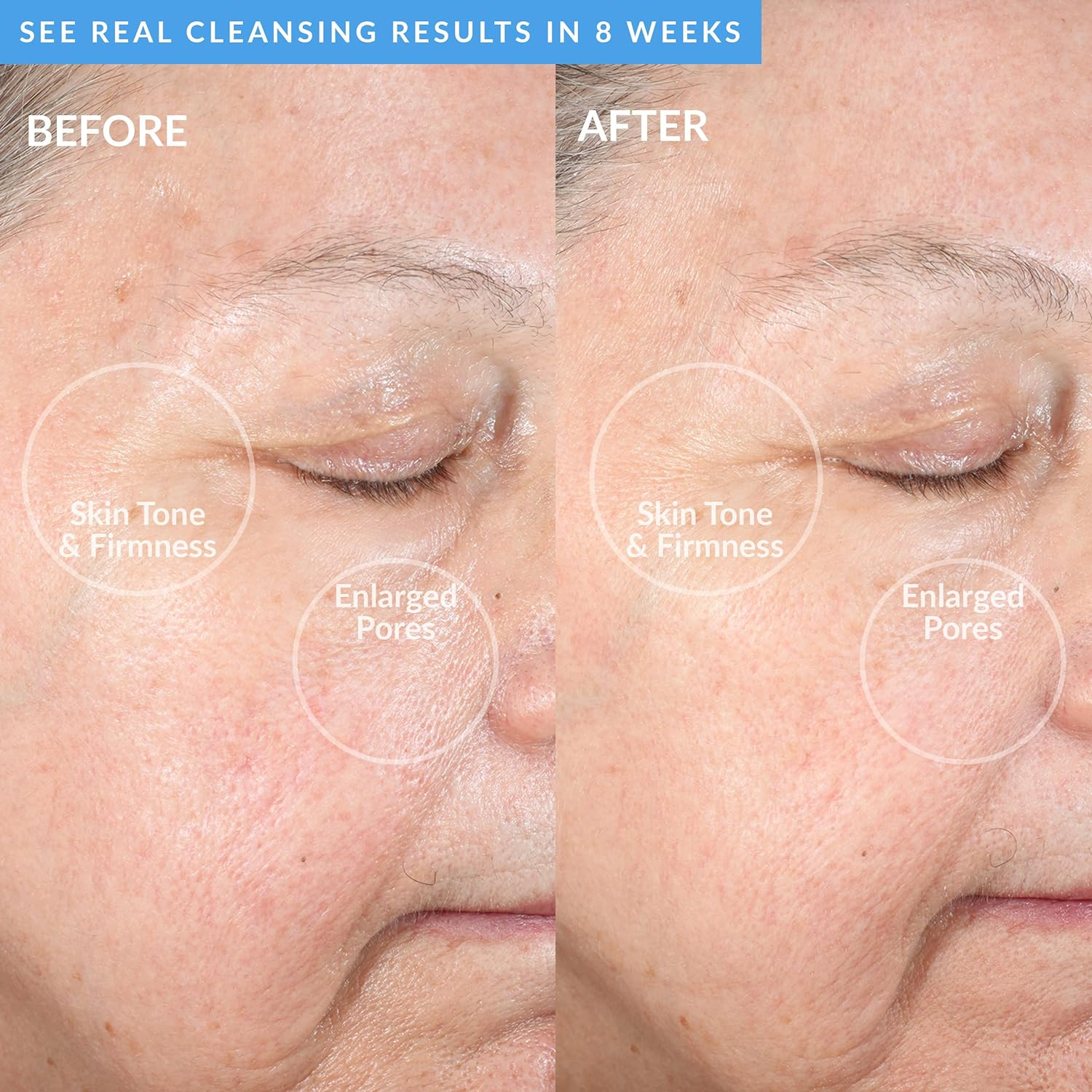 PMD Clean Acne - Smart Facial Cleansing Device with Silicone Brush & Acne-Fighting Blue Light Therapy Treatment - Waterproof - Sonicglow Vibration Technology - Clear Pores, Blackheads, and Acne image number 1