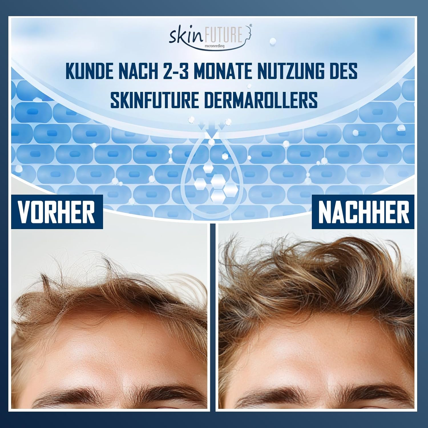 Efficient Microneedling Derma Roller Men - 192 Real Stainless Steel Needles against Hair Loss | Hair Roller & Beard Roller for Hair Growth | Minoxidil Compatible | Beard Care Tool - Skinfuture&reg; image number 4