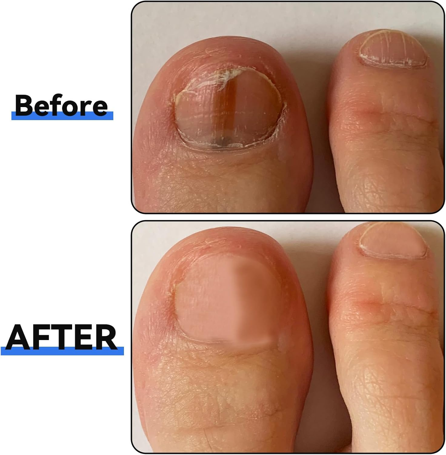 Dimeho 2 Pcs Toe Nail Files for Thick Nails, Professional Stainless Steel Nail File 4 Sides Fingernail Files with Anti-Slip Handle Dog Nail File Reusable Manicure Filer for Men Seniors and Dogs image number 1