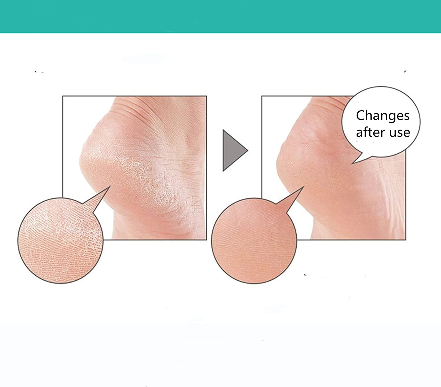 Heel Moisturizing Socks for Cracked Heel Treatmentstop Cracked Heels in Their Tracks Plantar Fasciitis Insert Pad Gel Heel Cushion Silica （ 2 Pairs） image number 4