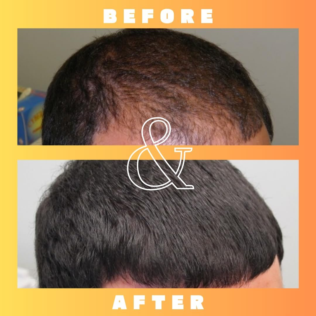 Mettle Mane - RU58841 5% Solution (50Mg/Ml) Hair Serum - 30Ml Bottle image number 1