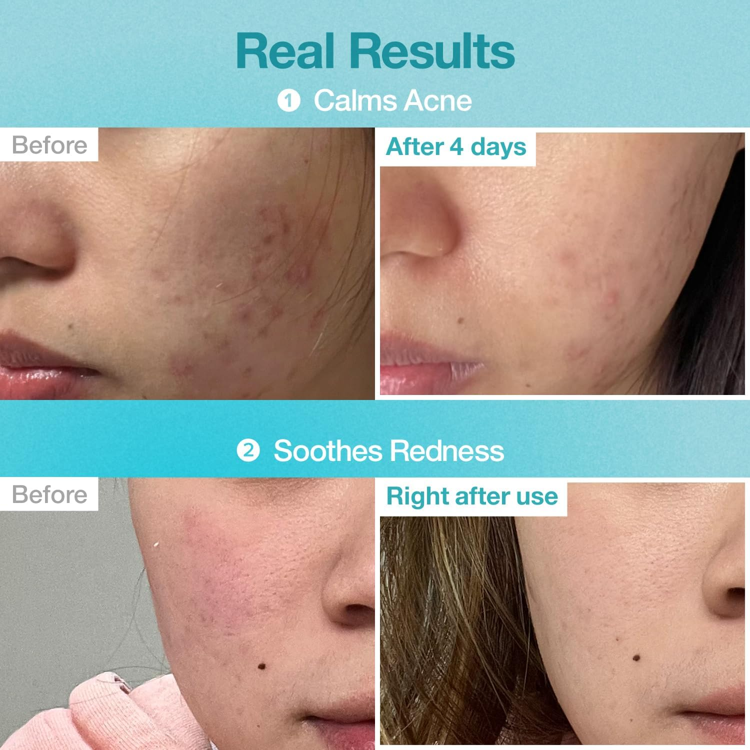 Numbuzin No.1 Sheet Mask | Pantothenic B5 Hyaluronic Active Clear Mask | Calming, Soothing, Hydrating | Acne Prone Skin | Controls Excess Oil, Reduces Redness, Safe for Sensitive Skin | 4 Sheets image number 2