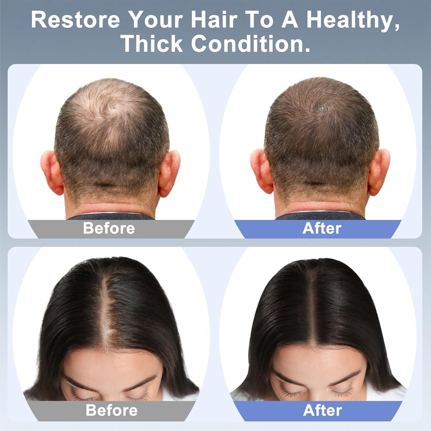 Etyceun Red Light Hair Growth Cap, Hair Growth and Anti-Hair Loss, 4 Modes with Removable Panel, 630 Nm + 450 Nm + 850 Nm, Hair Growth Cap, Adjustable Size, Hair Growth Acceleration for Men/Women