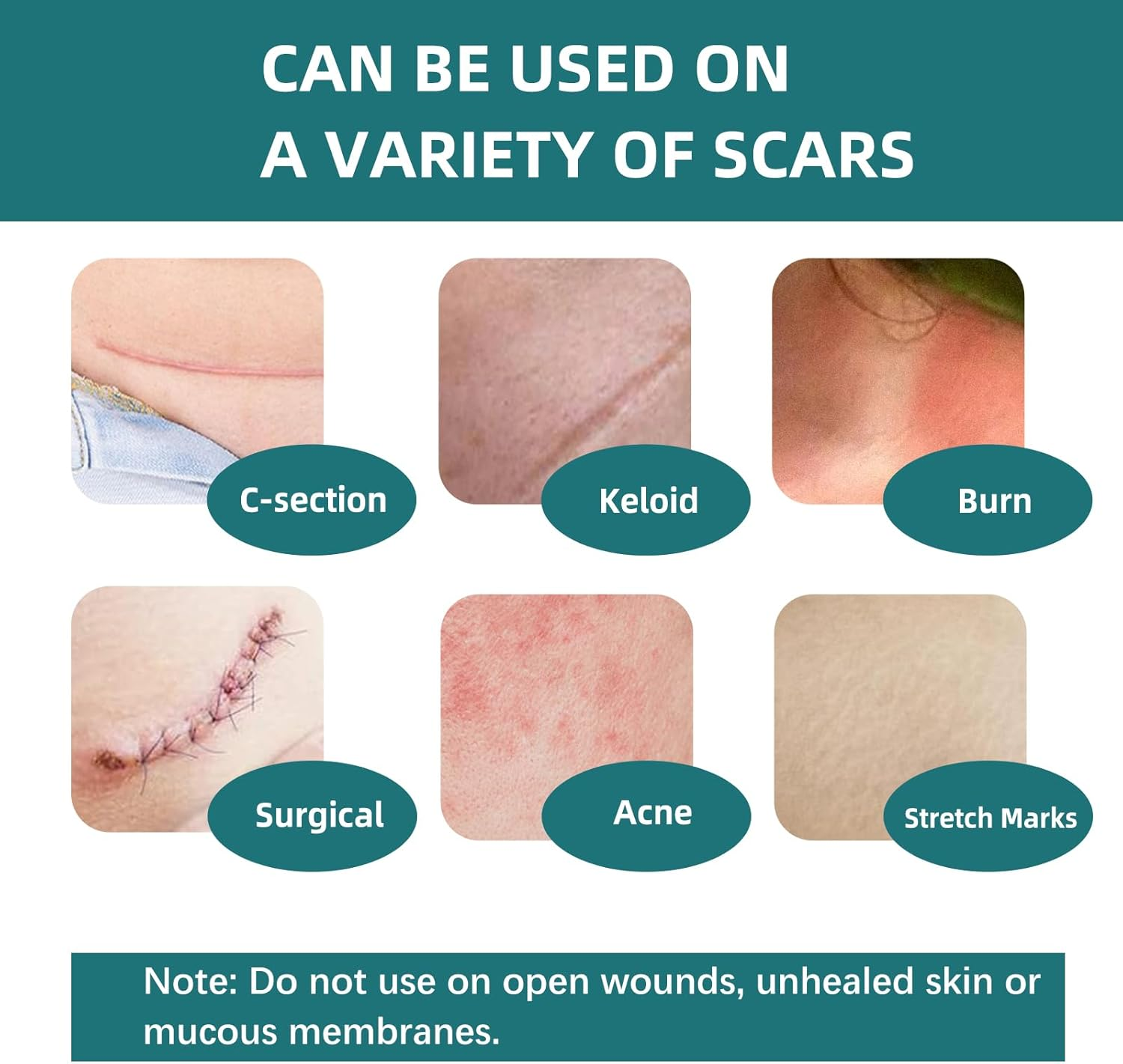 Silicone Scar Tape for Surgical Scars: Medical Grade Scar Gel Sheets for C-Section Tummy Tuck Recovery and Treatment &ndash; Reusable Scar Strips for Keloid Burn Acne Scars Removal (1.6'' X 60''Roll-1.5M) image number 3