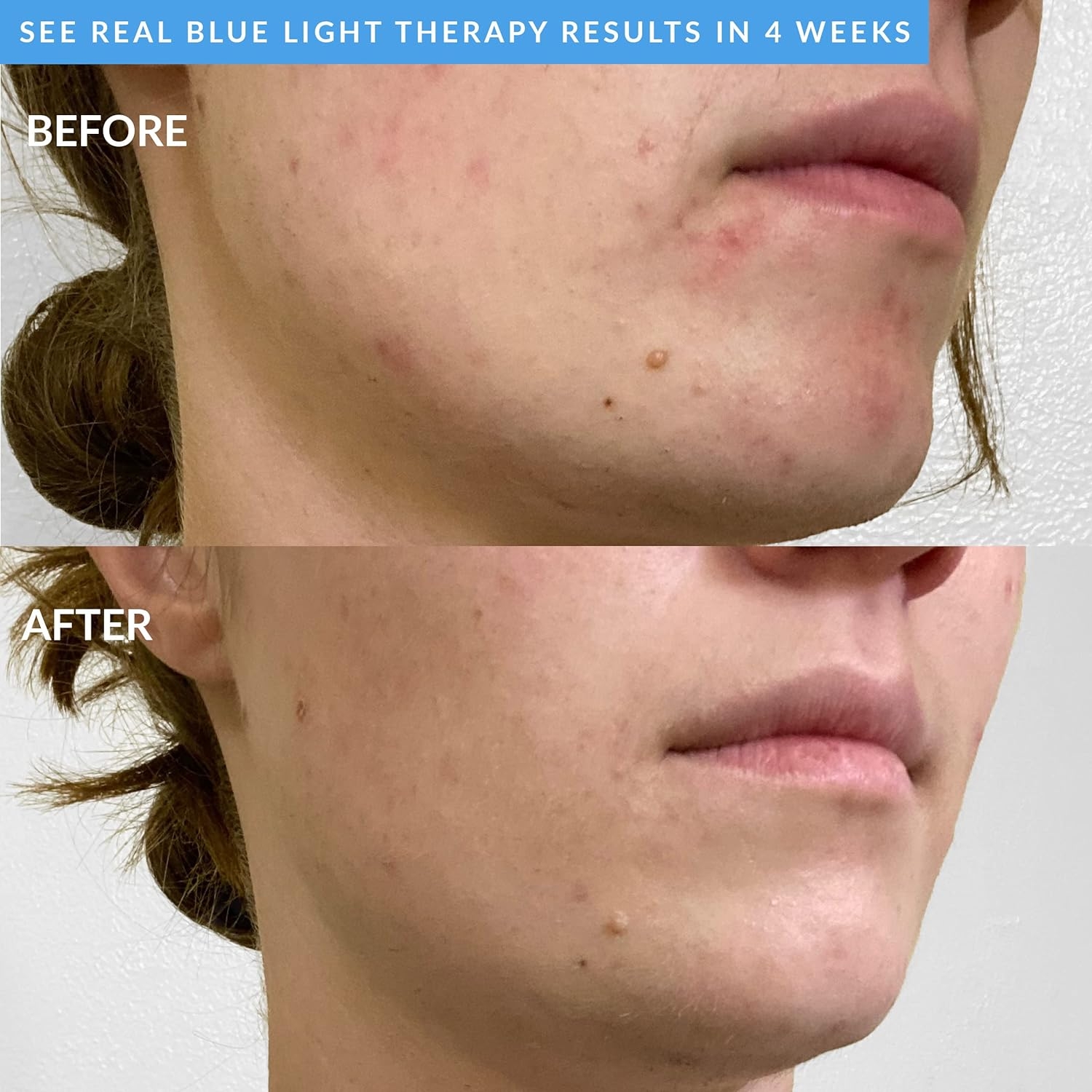 PMD Clean Acne - Smart Facial Cleansing Device with Silicone Brush & Acne-Fighting Blue Light Therapy Treatment - Waterproof - Sonicglow Vibration Technology - Clear Pores, Blackheads, and Acne