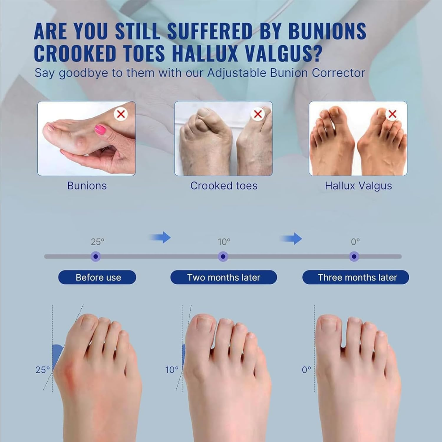 Effective Bunion Corrector for Women and Men | Relieve Pain, Straighten Toes, and Correct Bunions | Orthopedic Toe Straightener | Best Bunion Corrector for Lasting Relief - Day & Overnight Support (Right)