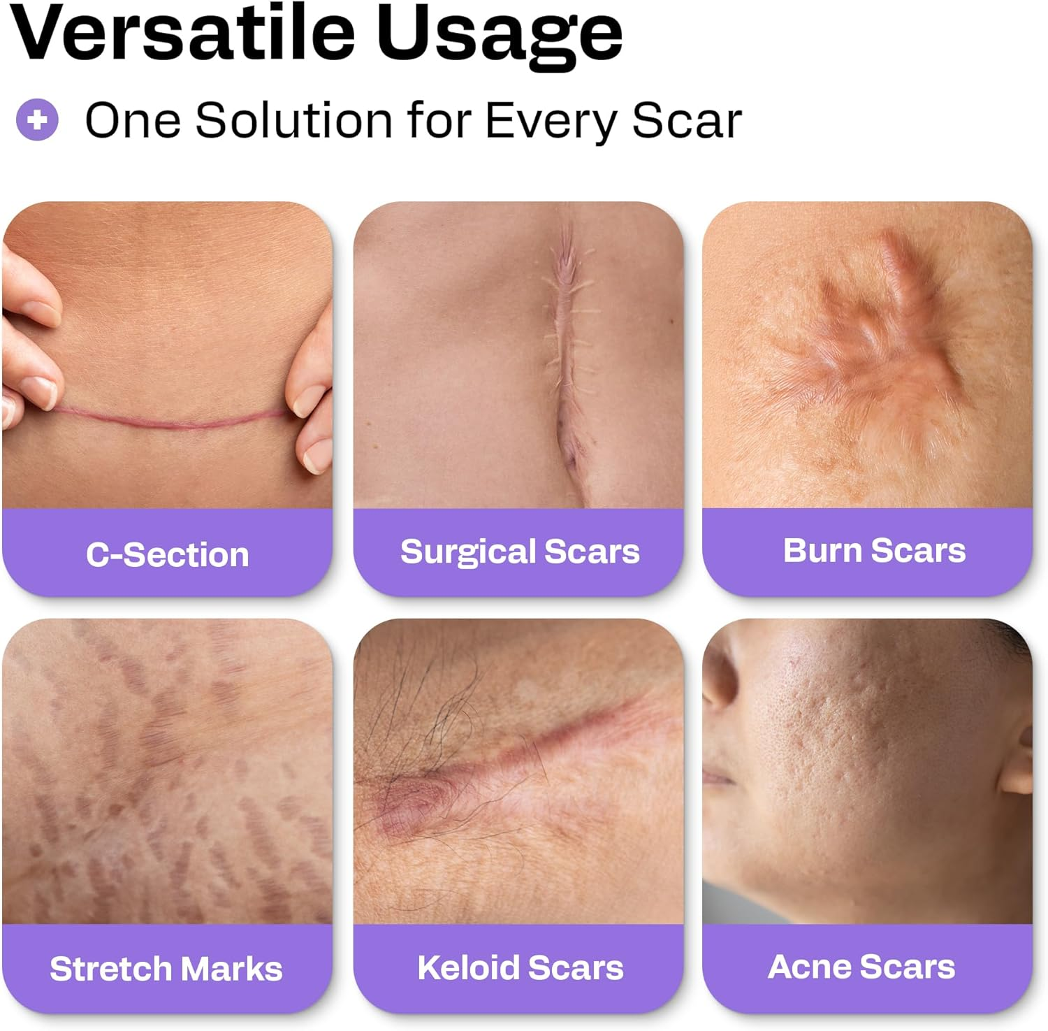 AWD Medical 100% Soft Silicone Gel Tape (1.6" X 60") Highly Comfortable Painless 6-8 Month Supply Acne Scar Treatment C Section Keloid Surgery Premium Hospital Medical Grade (4.1Cm X 150Cm ) image number 3