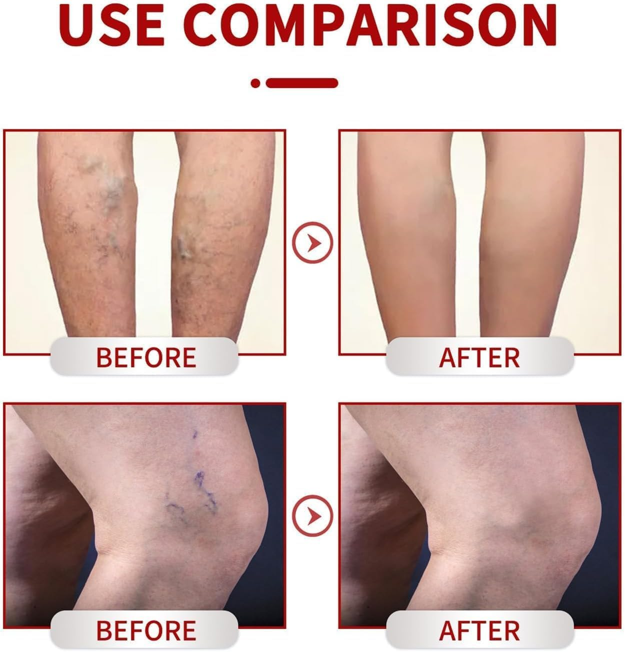 3 Pcs Medilisk Cream Varicose Veins,Medilisk Varicose Veins Relief Cream,Varicose Veins Treatment for Legs,Remove Varicose Veins, Improves Blood Circulation image number 4