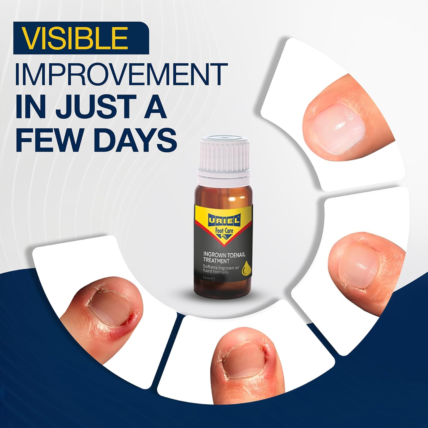 URIEL UPGRADED Ingrown Toenail Treatment, Ingrown Toenail Removal Kit, Ingrown Toenail Corrector, Ingrown Nail Kit Ingrown Toenail Tool 20Ml image number 6