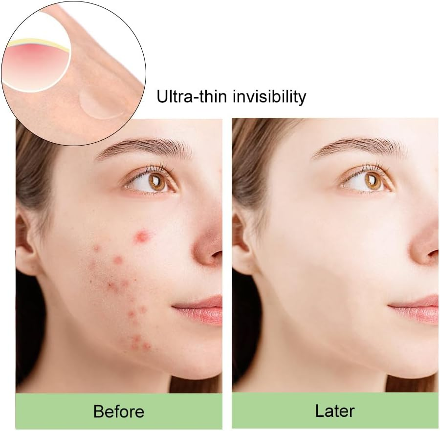 Pimple Patches for Face 150 Pack &ndash; Hydrocolloid Pimple Stickers for Blemish Care, Oil Absorbing Spot Dots for Clear Looking Skin, Gentle on Sensitive Skin (72 Patches) image number 1